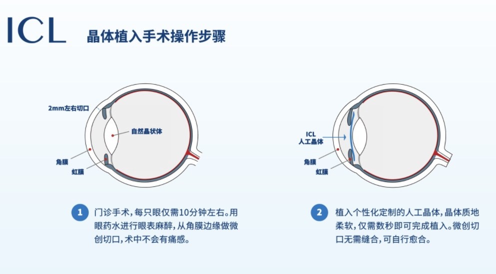 icl晶体植入手术过程www.360tu#lou.com