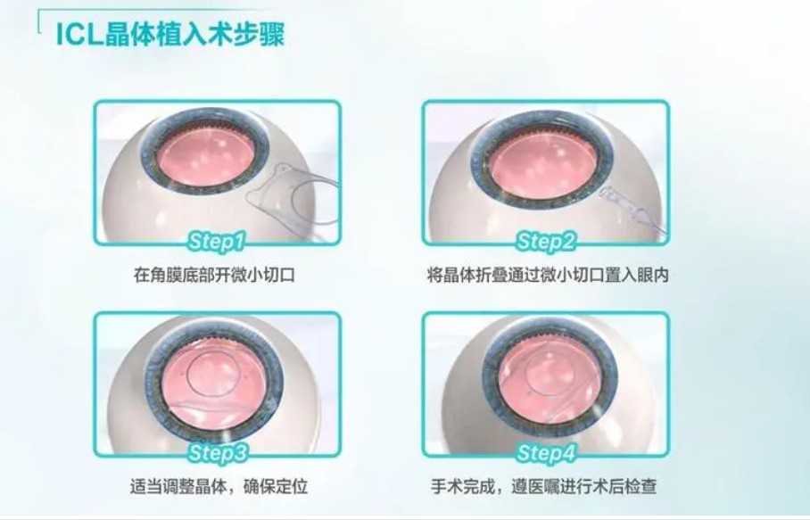 TICL晶体植入费用明细