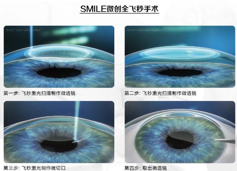 全飞秒近视手术价格多少钱