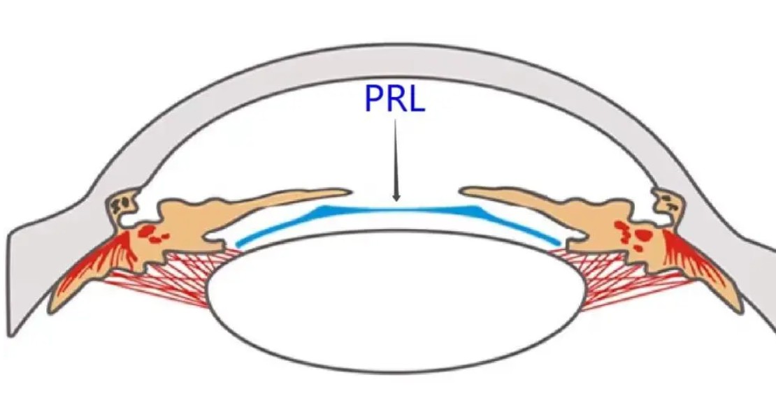 ICL晶体、TICL晶体和PRL晶体哪个好